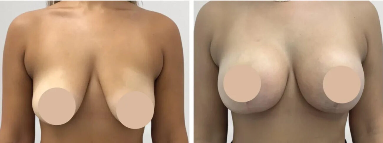 Breast lift in Dubai