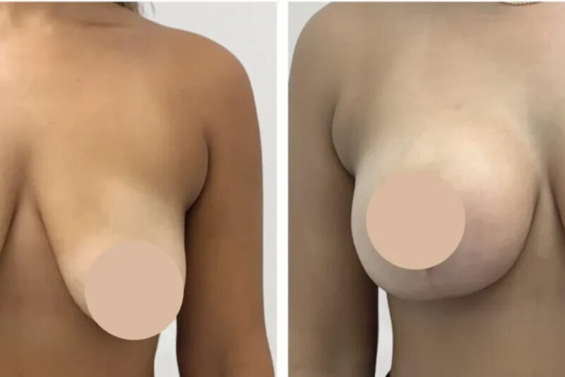 Why Women Choose Best Doctors in Dubai for Breast Lift Rejuvenation