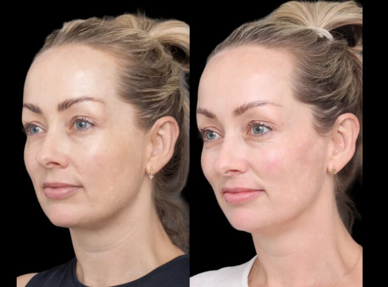 under eye fillers