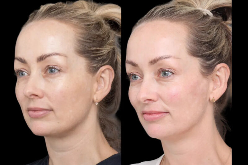 How Best Doctors in Dubai Plan Cheek Fillers