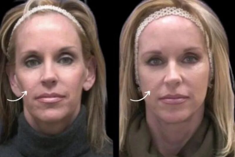 Best Doctors in Dubai Explain Sculptra Fillers Healing Tips