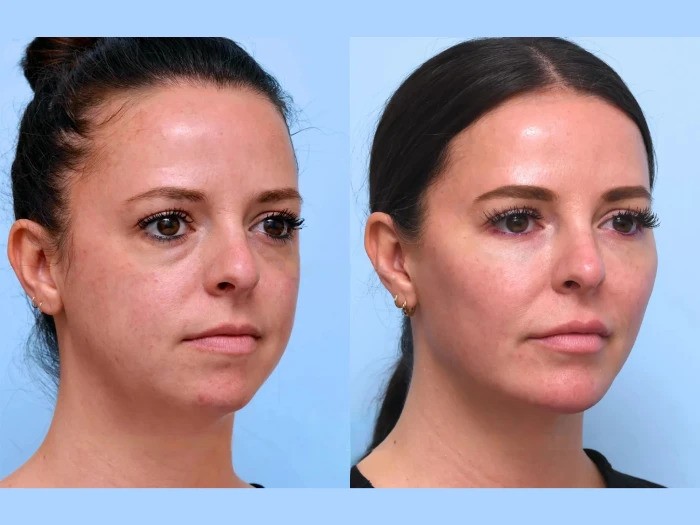 Thread Lift for Youthful Contours at Best Aesthetic Clinic in Dubai