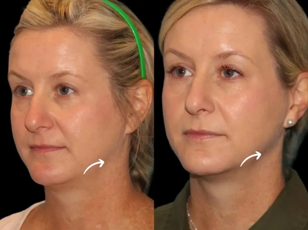 sculptra fillers in dubai