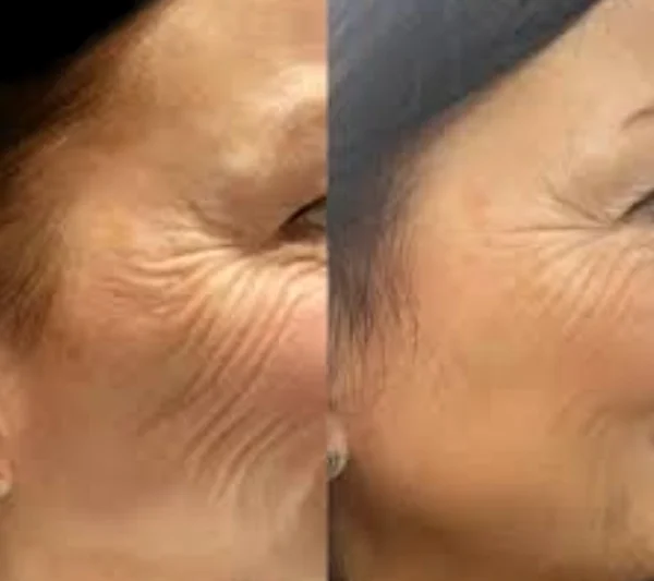 Profhilo Expertise Delivered by Best Doctors in Dubai