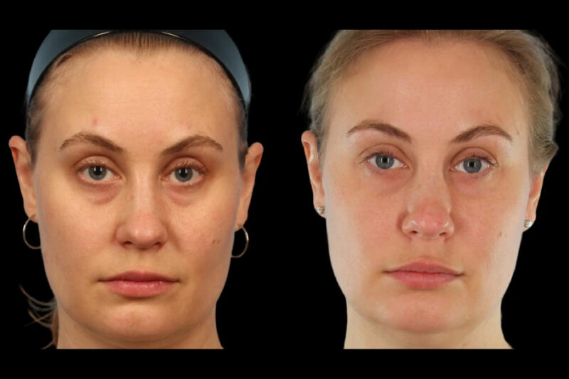 Under Eye Fillers for Subtle Enhancement by the Best Doctors in Dubai