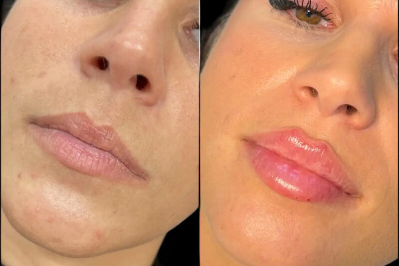 Choosing the Right Clinic for Fillers Treatment in Dubai