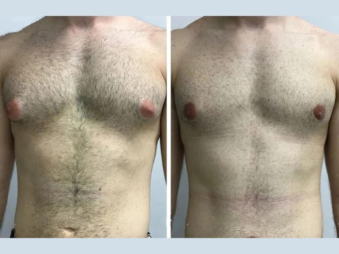 Advanced Techniques Used by the Best Gynecomastia Surgeons in Dubai