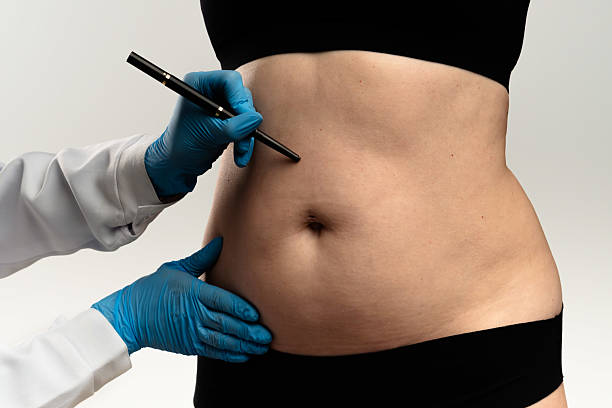 How Does Liposuction Surgery Compare to Tummy Tucks?
