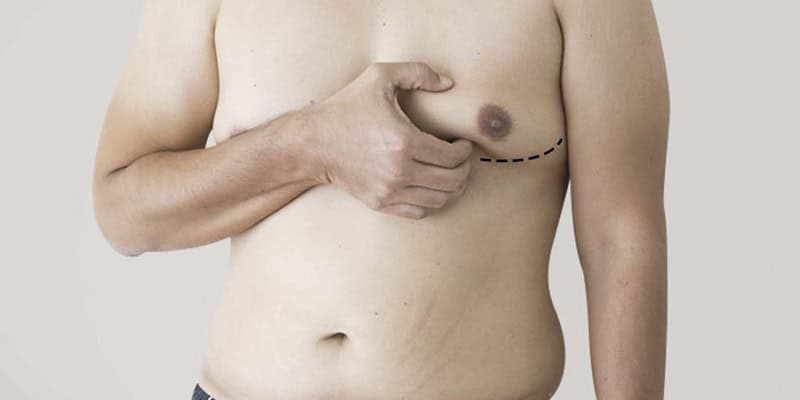 How Gynecomastia Surgery Helps Boost Self-Confidence