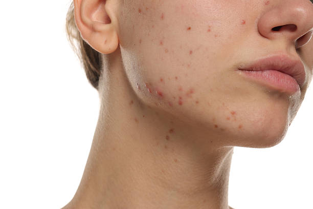 How Often Should Acne Treatment Be Applied for Best Results