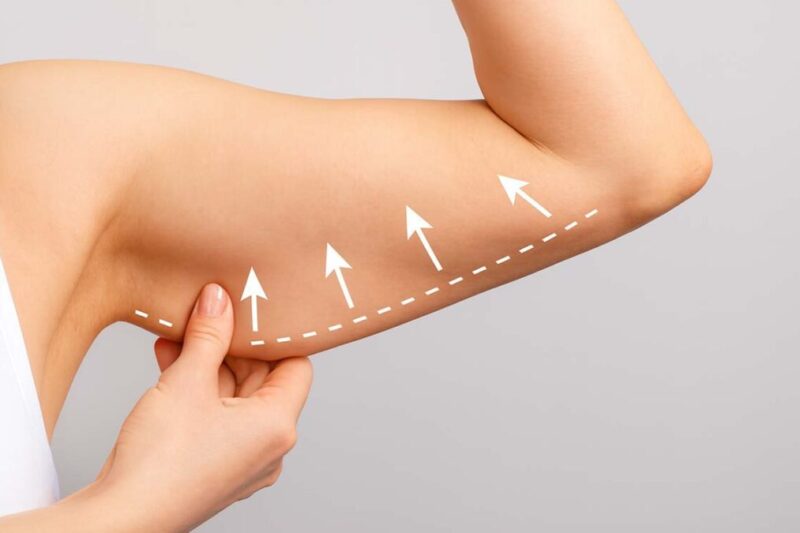 How Painful Is an Arm Lift After Surgery?