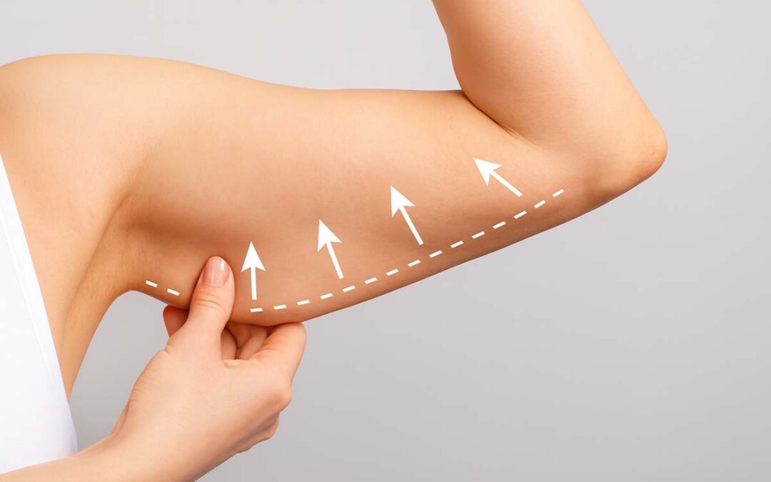 How Painful Is an Arm Lift After Surgery?