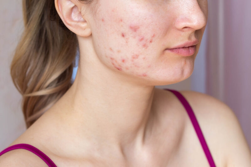 How Safe Is Acne Scar Treatment for Face