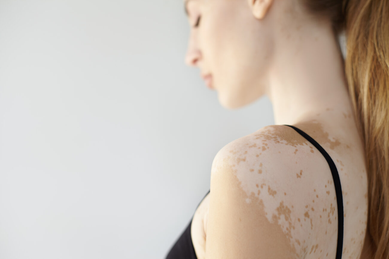 How Safe Is Vitiligo Treatment for Sensitive Skin