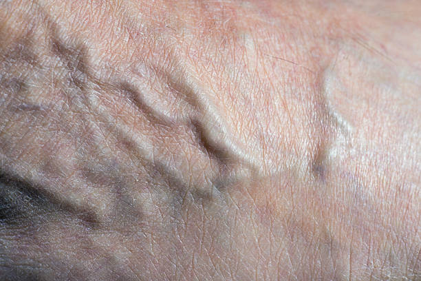 How Sclerotherapy Works to Treat Spider Veins Fast?