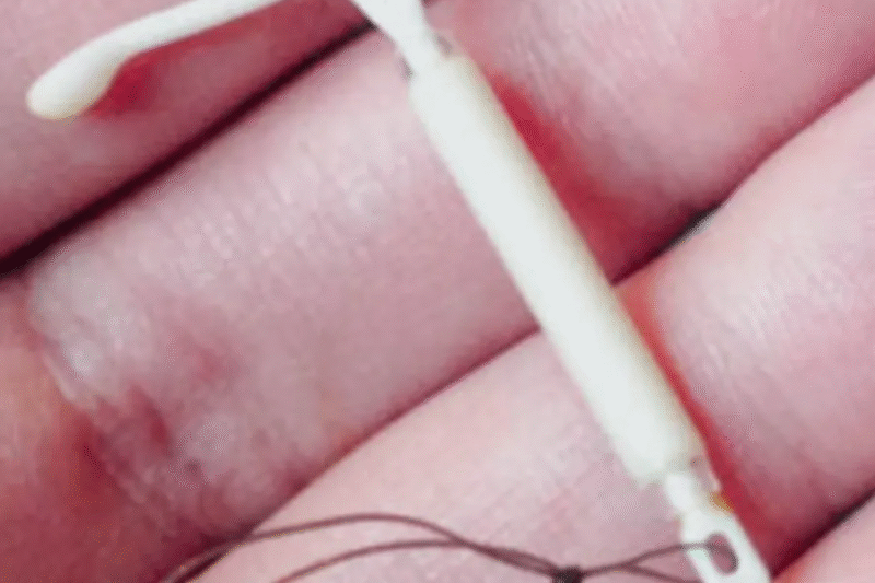 How Soon Can Copper T Be Removed Safely