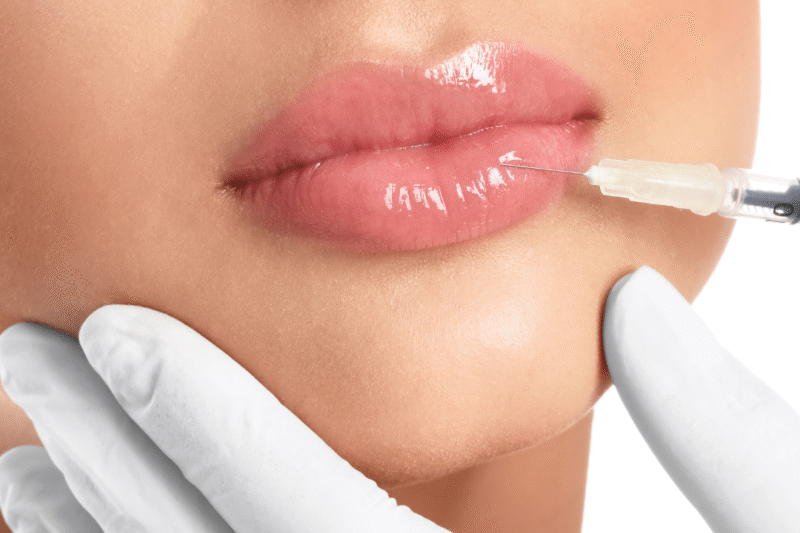 How Successful Are Russian lip Fillers Results