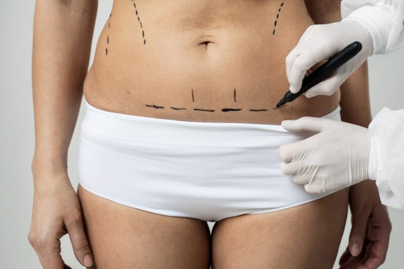 How Waist Sculpting Compares to Diet and Gym