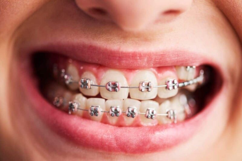 How to Choose the Right Dental Braces for Your Needs?