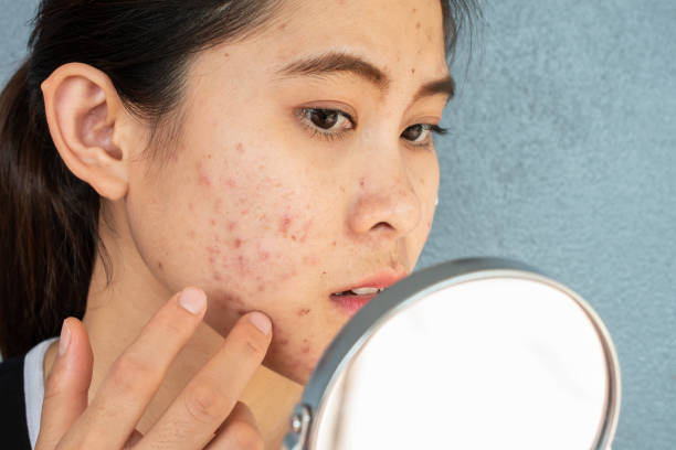 Is Acne Treatment a Solution for Stress-Related Acne