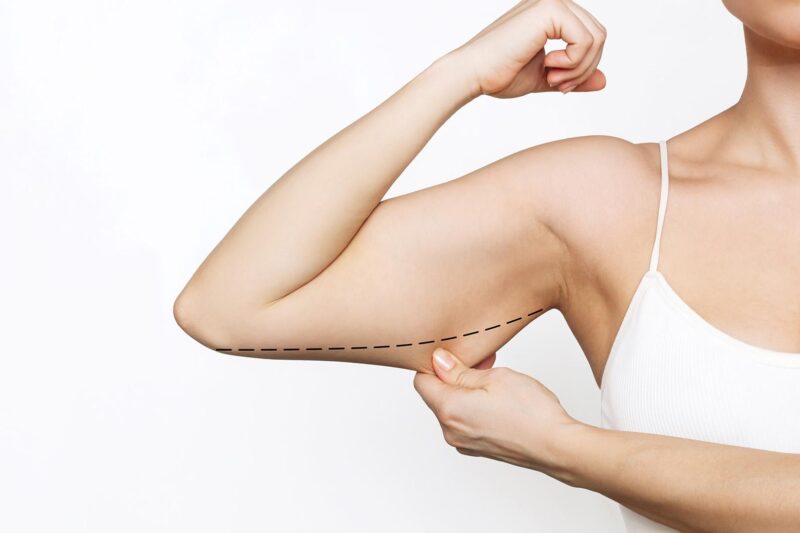 Is Arm Lift Painful or Manageable