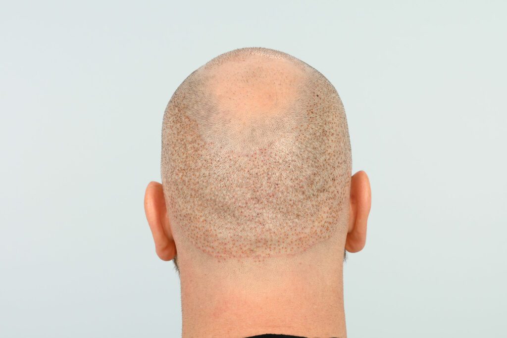 Is Crown Hair Transplant Suitable for Severe Baldness