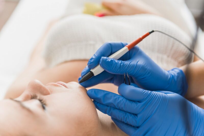 Is Electrolysis Laser Hair Removal a Permanent Option