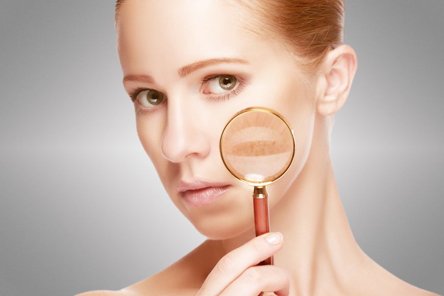 Is Melasma Treatment Suitable for Sensitive Skin