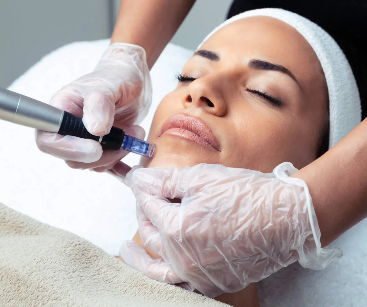 Is Microneedling for Acne Scars Painful or Uncomfortable