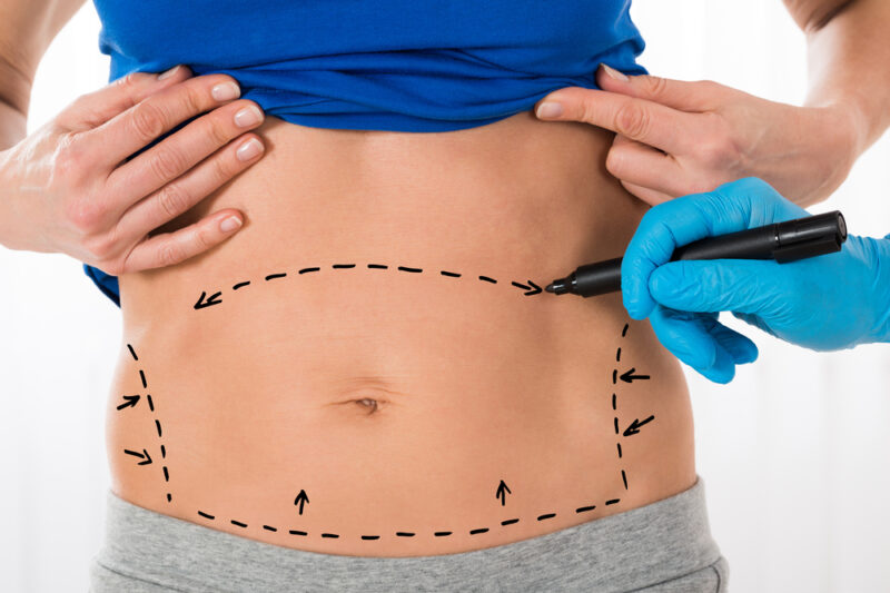 Is Mini Abdominoplasty a Permanent Solution