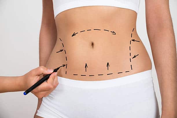 Mini Abdominoplasty A Less Invasive Tummy Tuck Option