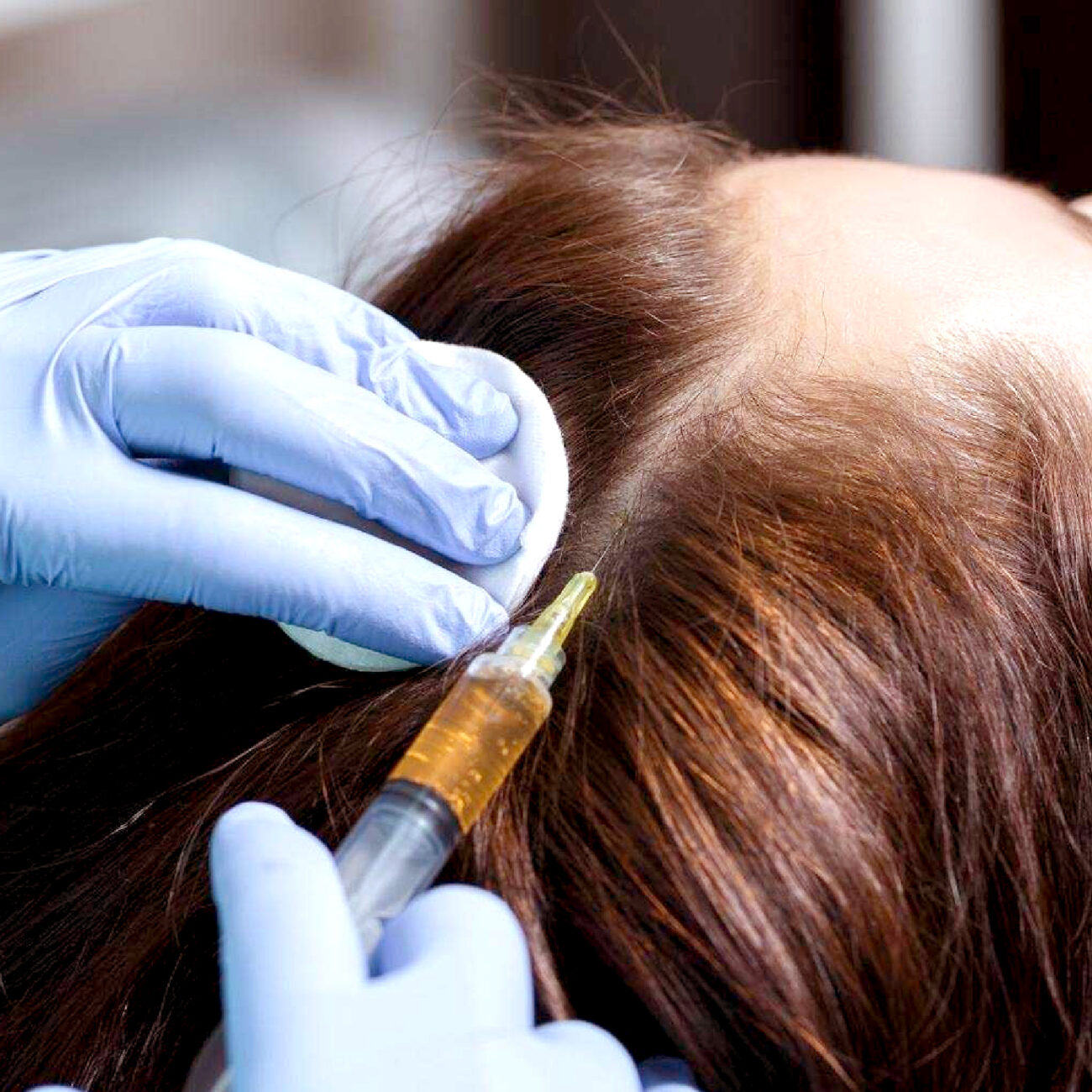 PRP Treatment for Thicker, Healthier Hair