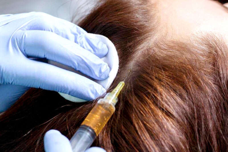 PRP Treatment for Thicker, Healthier Hair