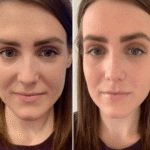 Prp Treatment in Dubai