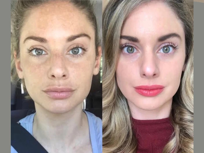 Radiofrequency (RF) Microneedling in Dubai for Clear, Smooth Skin