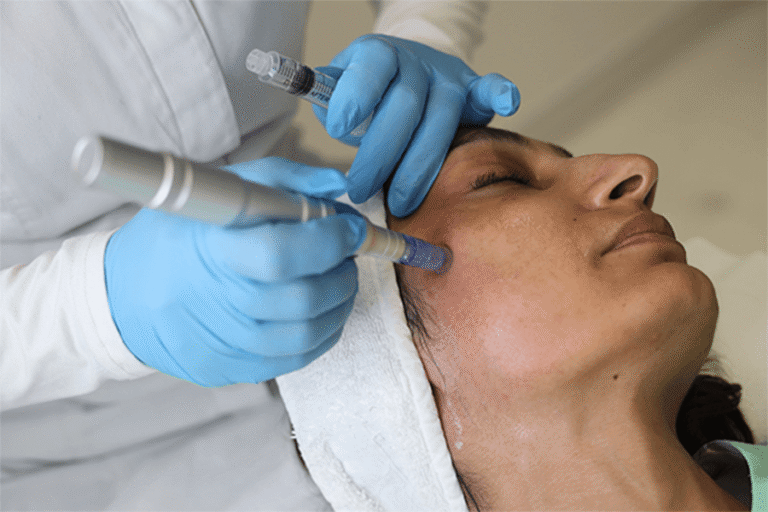 Restore Skin Confidence with RF Microneedling