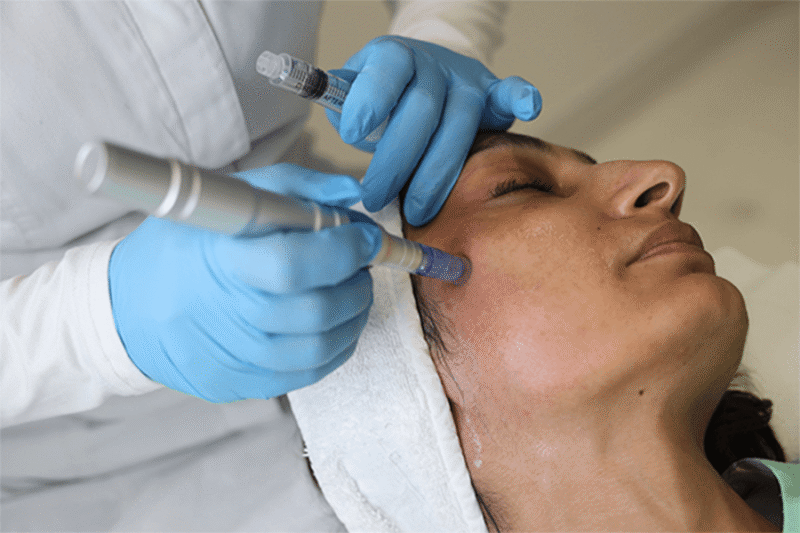 Restore Skin Confidence with RF Microneedling