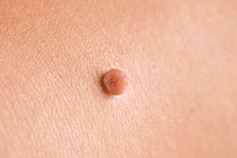 Skin Tag Removal Consultation Guide