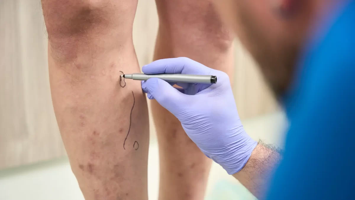 Treat Spider Veins Quickly and Safely