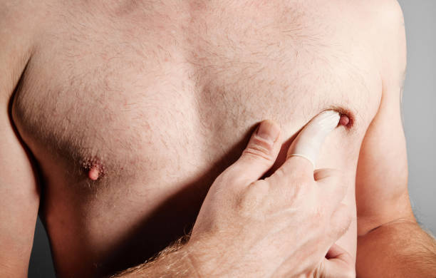 What Happens During Gynecomastia Surgery?