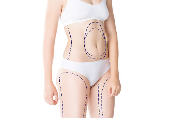 What Makes Liposuction a Popular Fat Reduction Option