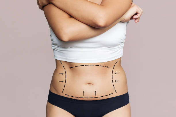 What Makes Tummy Tuck So Popular Globally?