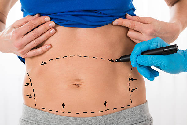 What Makes Tummy Tuck a Popular Cosmetic Treatment