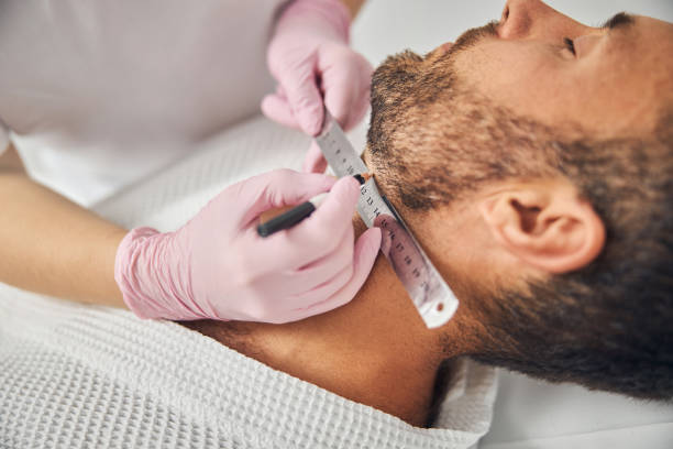 What Techniques Are Used in Beard Hair Transplant