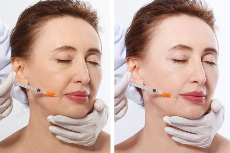 Where Science Meets Beauty Dermal Fillers