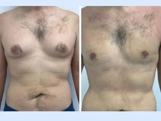Why the Best Gynecomastia Surgeon in Dubai Are Trusted for Gynecomastia in Dubai