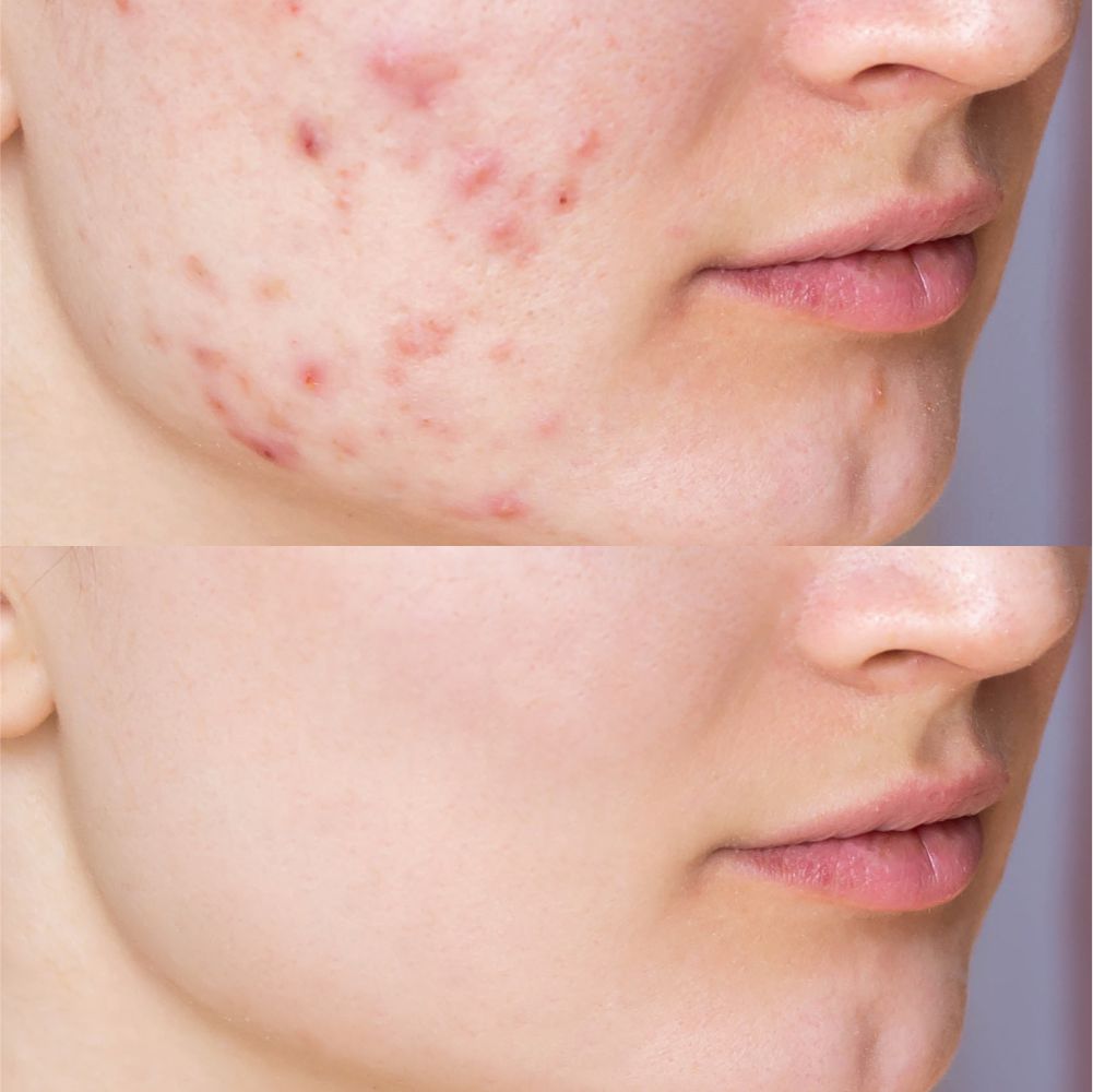 Acne Scar Treatment In Islamabad