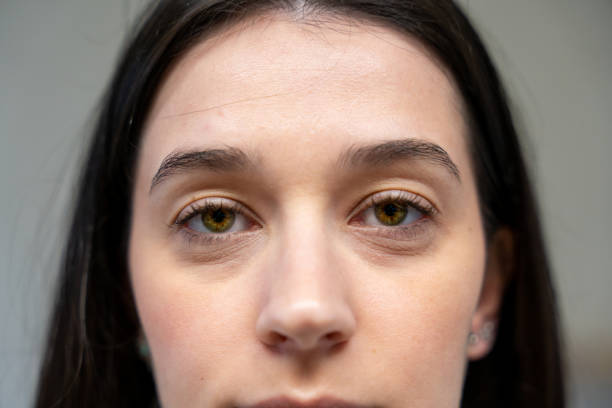 Are Under Eye Fillers a Good Anti-Aging Treatment?