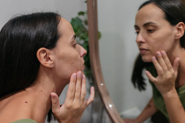 Beginner’s Guide to Effective Acne Treatment