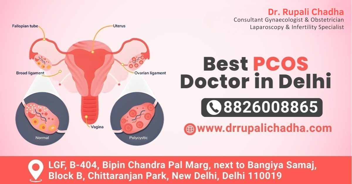 Best PCOS Doctor in Delhi